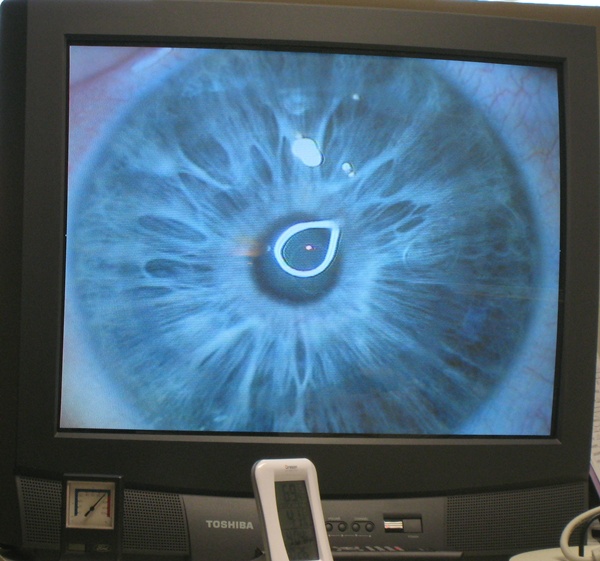 My eye with the outer layer of the cornea removed, ready for laser surgery.
